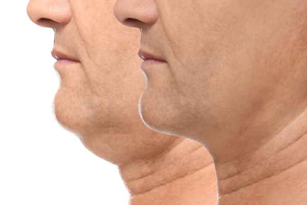 HIFU - Breakthrough in Anti - ageing 2 hifu results Wimborne