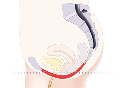 Pelvic-Floor Muscle Repair 5 Pelvic floor muscles Wimborne