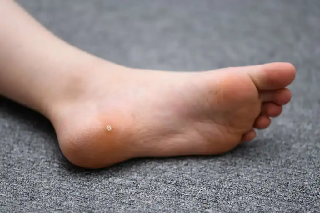 Cryotherapy For Warts And Also Verrucas 2 Image of verruca on the bottom of the foot that able to be treated with Cryotherapy Wimborne