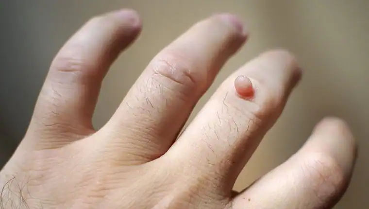 Image of blemish that Cryotherapy Wimborne can remove with Lipo 360.