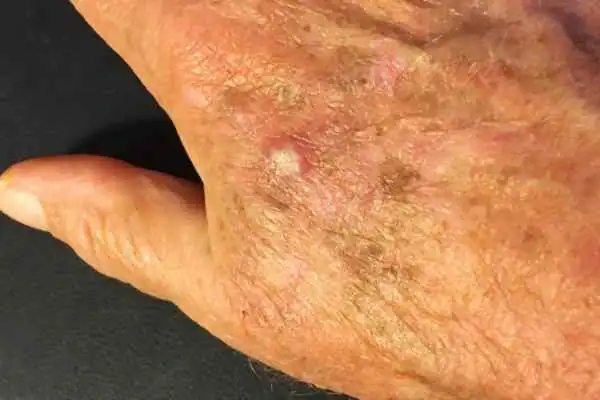 Cryopen For Actinic Keratoses 1 Image of Actinic keratoses Wimborne on a person hand