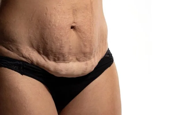 The Science of Skin Tightening 1 The science behind skin tightening Wimborne picture of a woman's sagging skin on the stomach